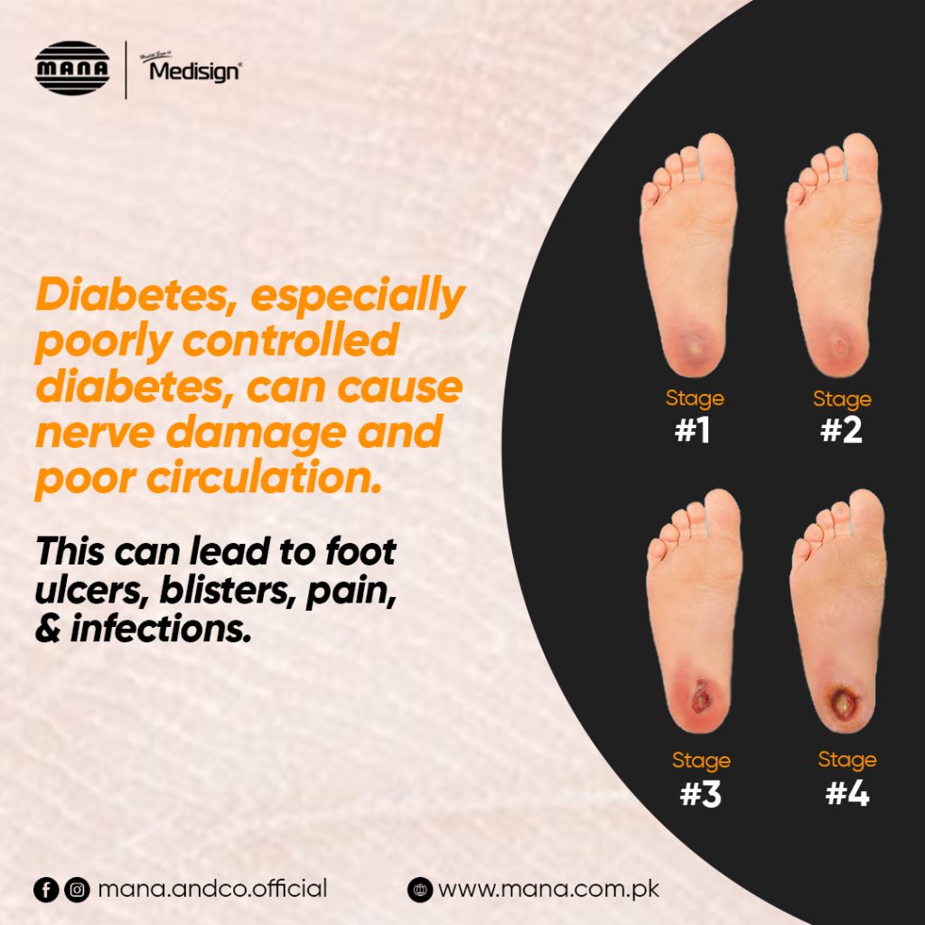 Foot Ulcer In Diabetes